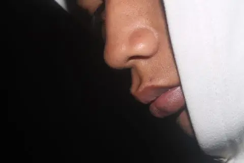 رینوپلاستی یا جراحی بینی: نکاتی که قبل از عمل باید بدانم رینوپلاستی یا جراحی بینی: نکاتی که قبل از عمل باید بدانم