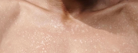 هیپوپیگمانتاسیون چرا به وجود می‌آید و درمان آن چیست؟