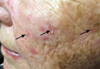 لیپوساکشن: آنچه از خطرات، مزایا، روش‌ها و نتایج آن باید بدانیم. 