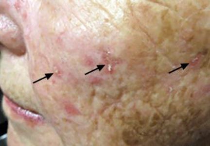 کراتوز اکتینیک یا ضایعات پیش‌سرطانی پوست چیست؟ علائم آن چگونه است؟