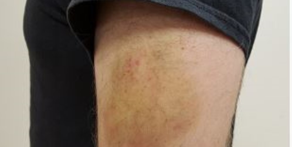 لیپوساکشن: آنچه از خطرات، مزایا، روش‌ها و نتایج آن باید بدانیم. 