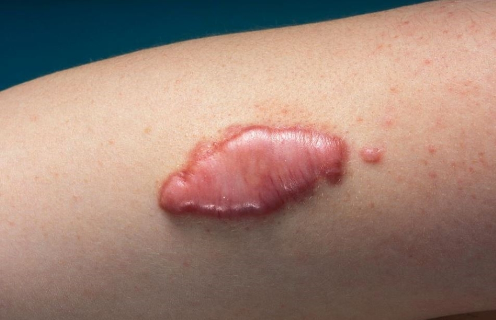 جای زخم یا اسکار (Scar) دقیقاً چیست و انواع آن چگونه است؟