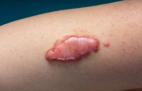 کلوئید چرا به وجود می‌آید و چه درمان‌هایی برای آن وجود دارد؟