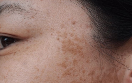 ملاسما چیست و چگونه ایجاد می‌شود؟ چه درمان‌هایی برای آن وجود دارد؟