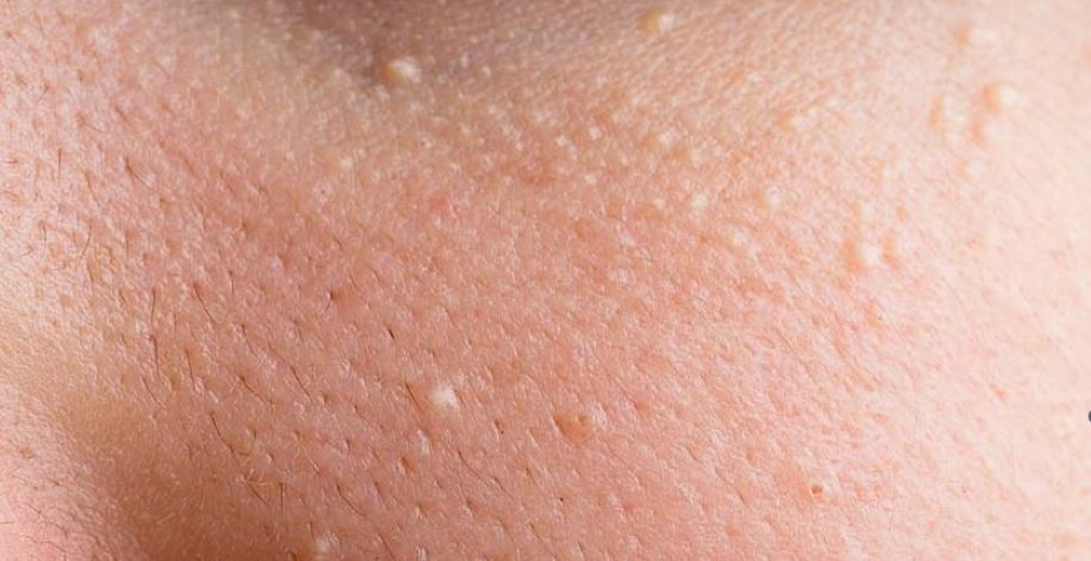 لایه‌بردای فنول یا پیلینگ شیمیایی فنول چیست؟ مزایا و هشدارهای ضروری