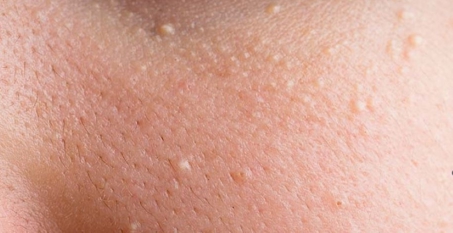 چه چیزی باعث میلیا می‌شود و چگونه درمان می‌شود؟