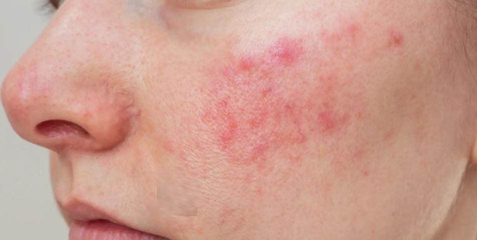 بوتاکس: کاربردها، مراحل تزریق، عوارض جانبی و برندها