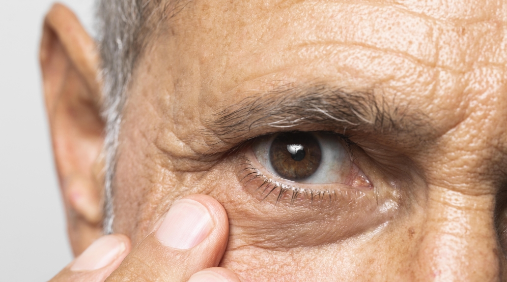 نکروز بر اثر تزریق فیلر چیست و چگونه اتفاق می‌افتد؟