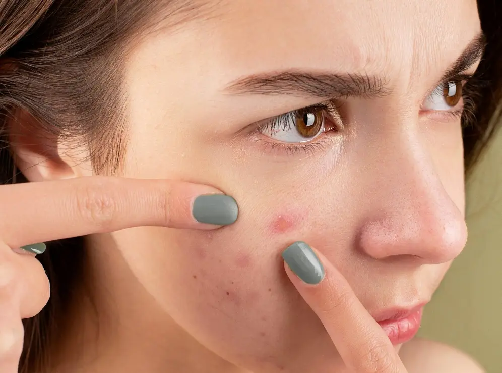اختلال پوستکَنی (کندن پوست) چیست؟ آیا درمانی وجود دارد؟ اختلال پوستکَنی (کندن پوست) چیست؟ آیا درمانی وجود دارد؟