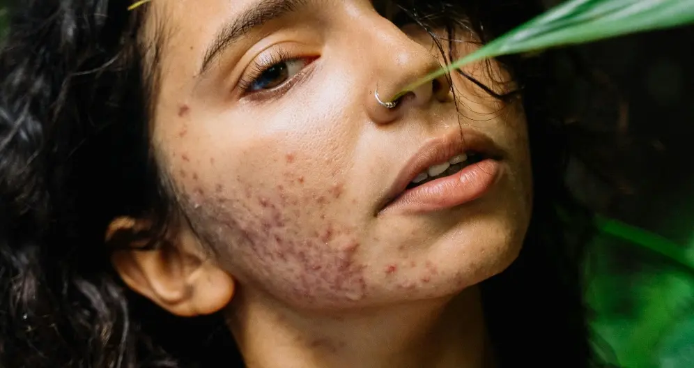 ایزوترتینوئین چیست؟ مزایا، تداخلات دارویی و عوارض جانبی ایزوترتینوئین چیست؟ مزایا، تداخلات دارویی و عوارض جانبی