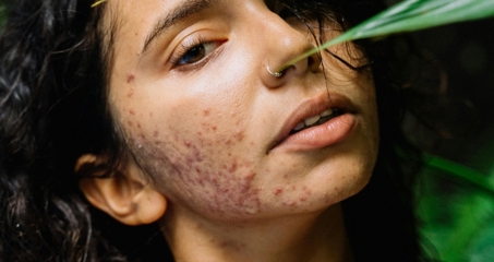 ایزوترتینوئین چیست؟ مزایا، تداخلات دارویی و عوارض جانبی