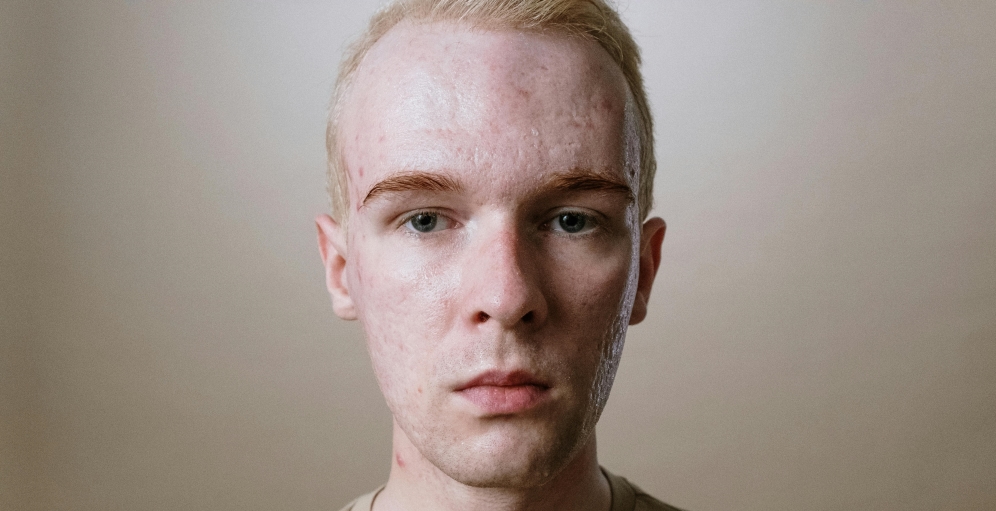 میکرودرم ابریژن چیست؟ روشهای انجام، عوارض جانبی، هزینه و...  میکرودرم ابریژن چیست؟ روشهای انجام، عوارض جانبی، هزینه و...