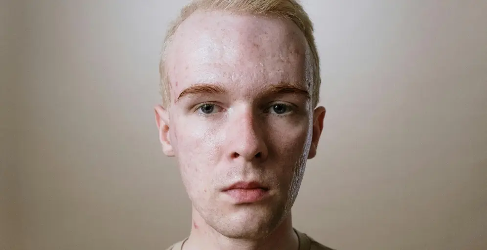 جای جوش و اسکار آکنه: چه درمانهایی دارد؟ جای جوش و اسکار آکنه: چه درمانهایی دارد؟