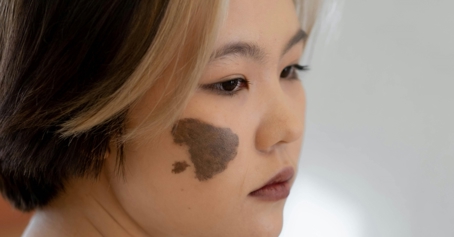 خال‌ها و علامت‌های مادرزادی چه هستند و چرا باید بررسی شود؟ 