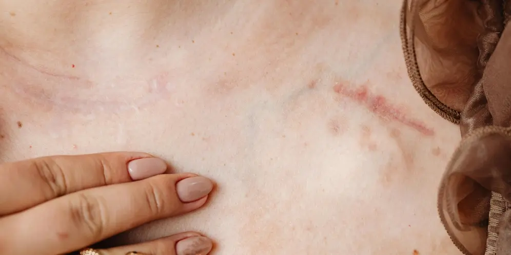 جای زخم یا اسکار (Scar) دقیقاً چیست و انواع آن چگونه است؟ جای زخم یا اسکار (Scar) دقیقاً چیست و انواع آن چگونه است؟