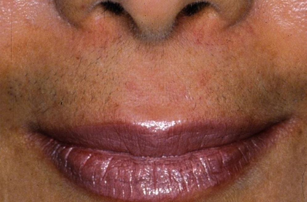 میکرودرم ابریژن چیست؟ روش‌های انجام، عوارض جانبی، هزینه و... 