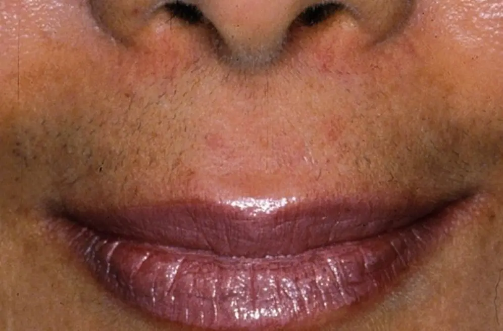 پرمویی در زنان چیست و چرا رخ می‌دهد؟