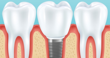  تبلیغ ایمپلنت فوری دروغ است/ سلبریتی‌ها حق تبلیغ خدمات پزشکی را ندارند.